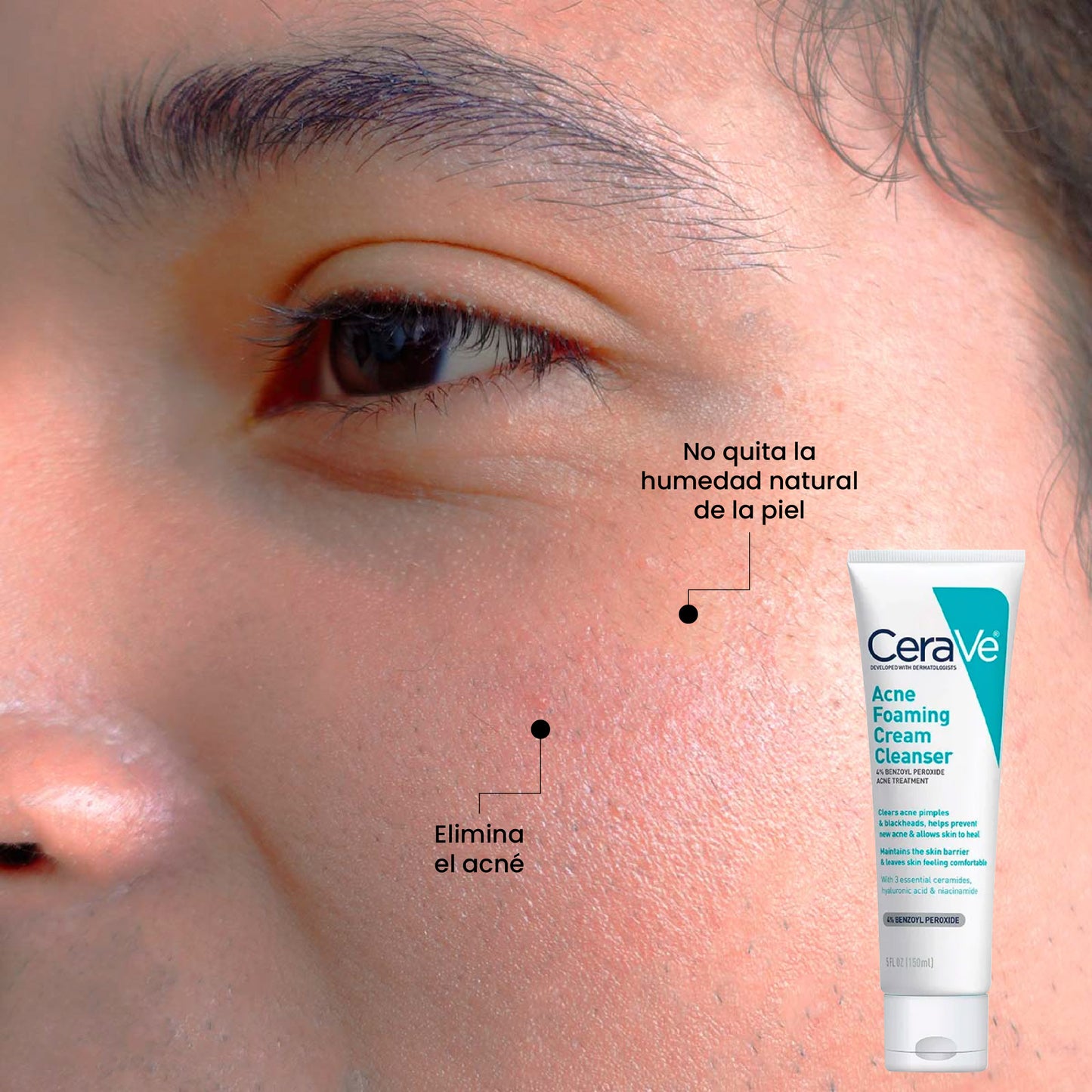 Crema Limpiadora Espumosa para el Acné | Beneficios | Uperfect Perú
