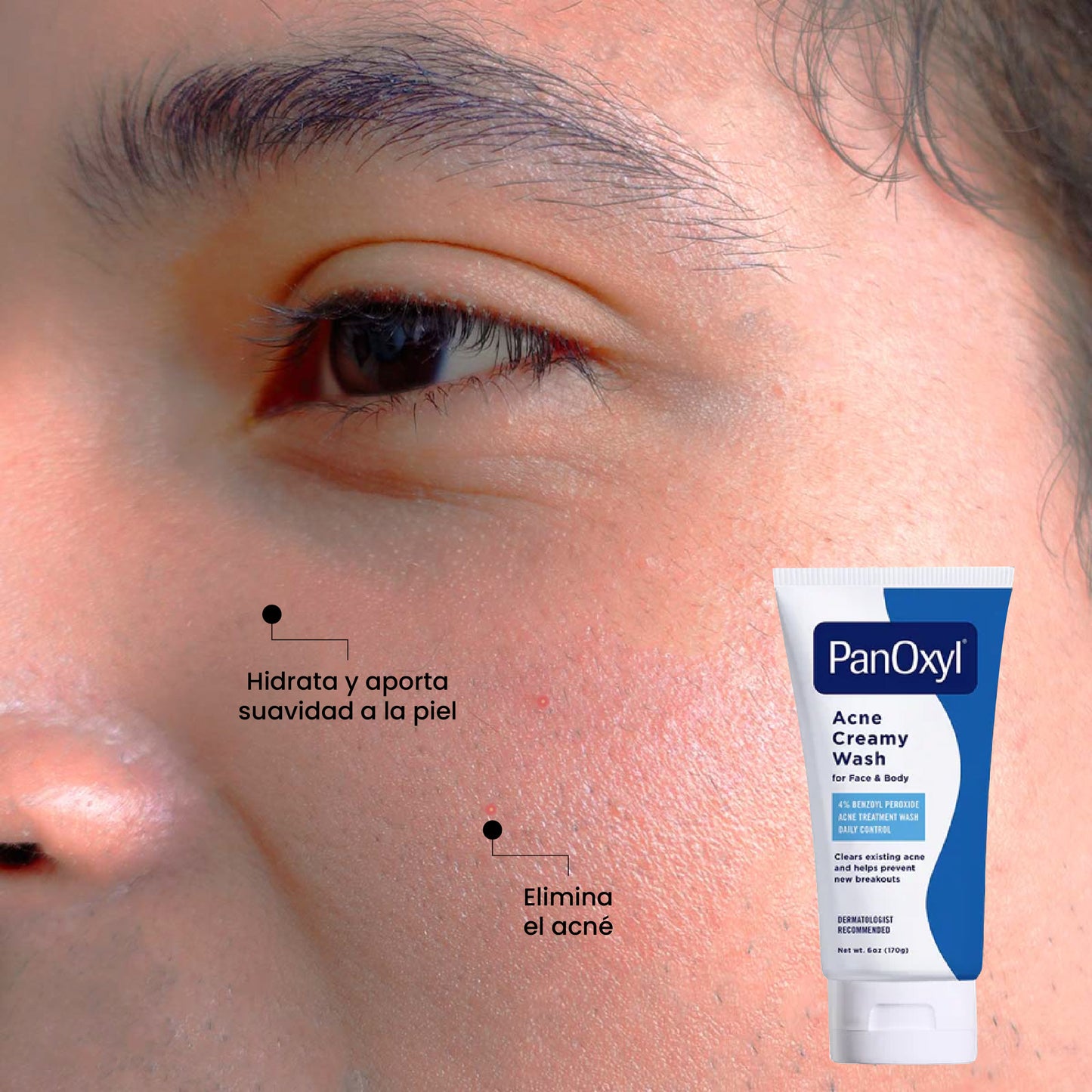 Limpiador Antiacne Cremoso 4% | Beneficios | Uperfect Perú